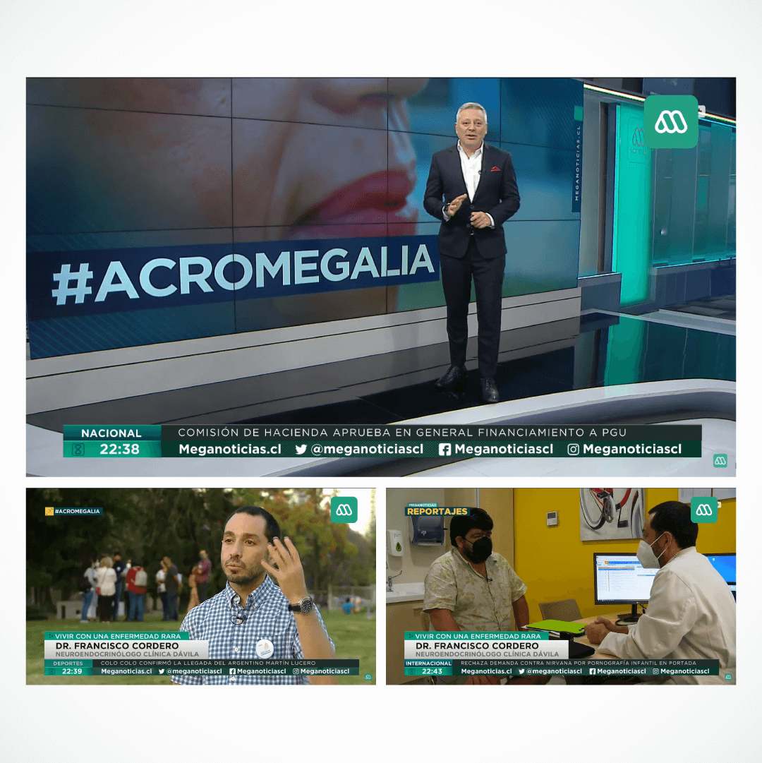 Sinérgica | Aparición en medios en comunicación | Mega Prime | Acromegalia Chile